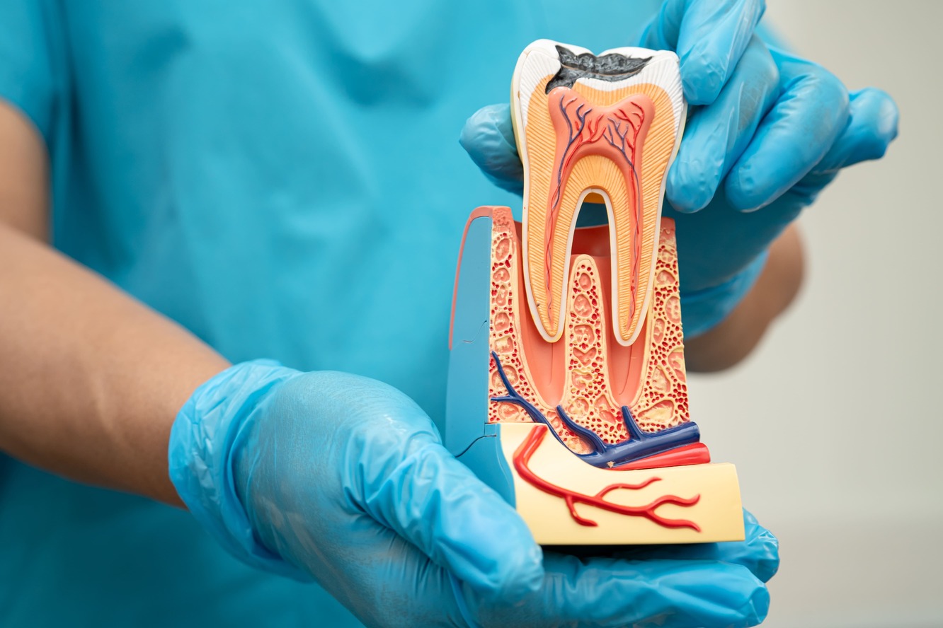 Root canal treatment demo at Dental Solutions HSR Layout