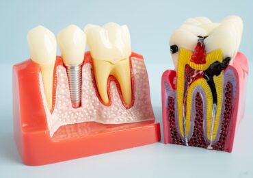 Dental Implants versus Root Canal Treatments