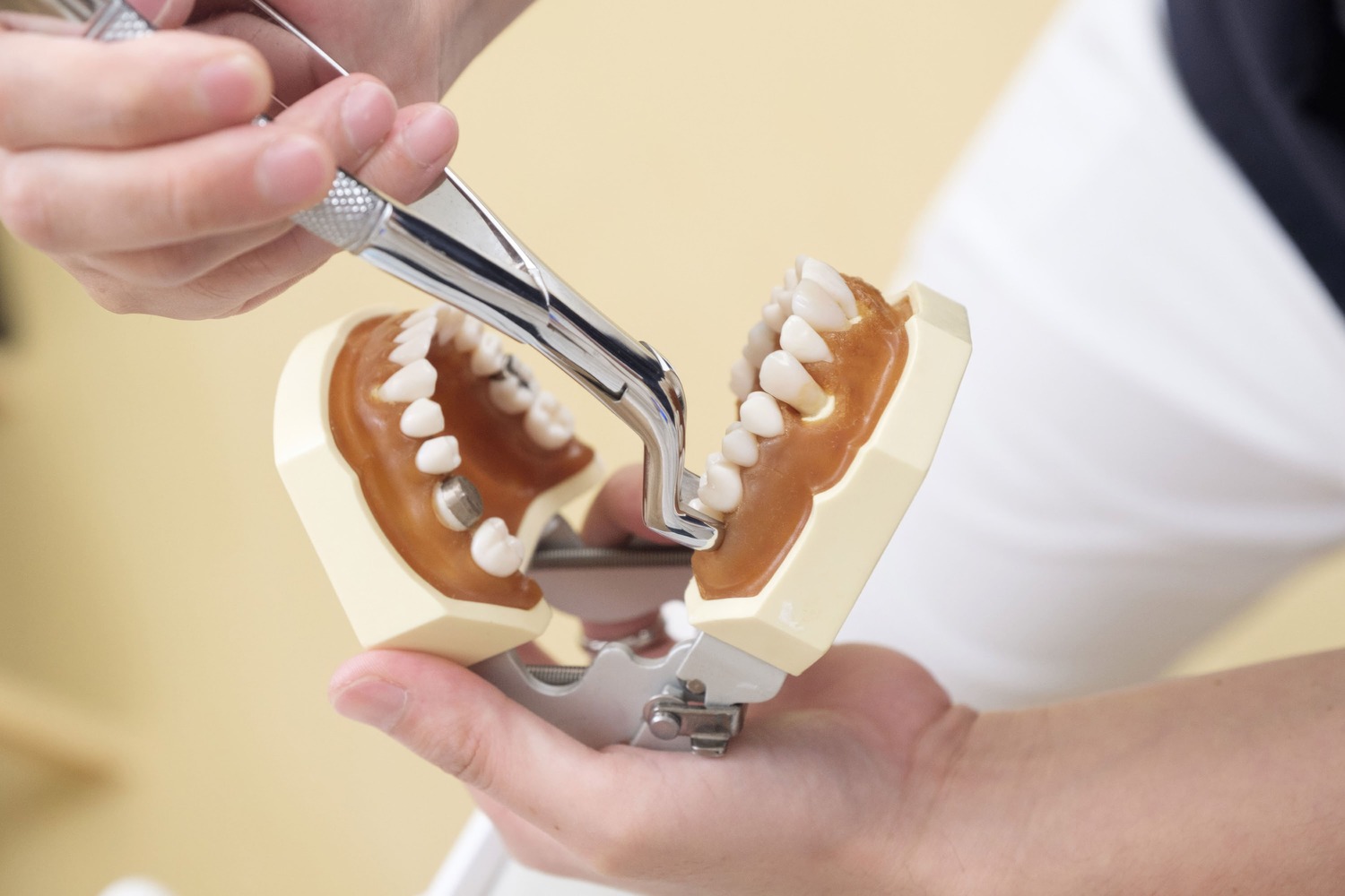 Tooth extraction demo at Dental Solutions HSR Layout