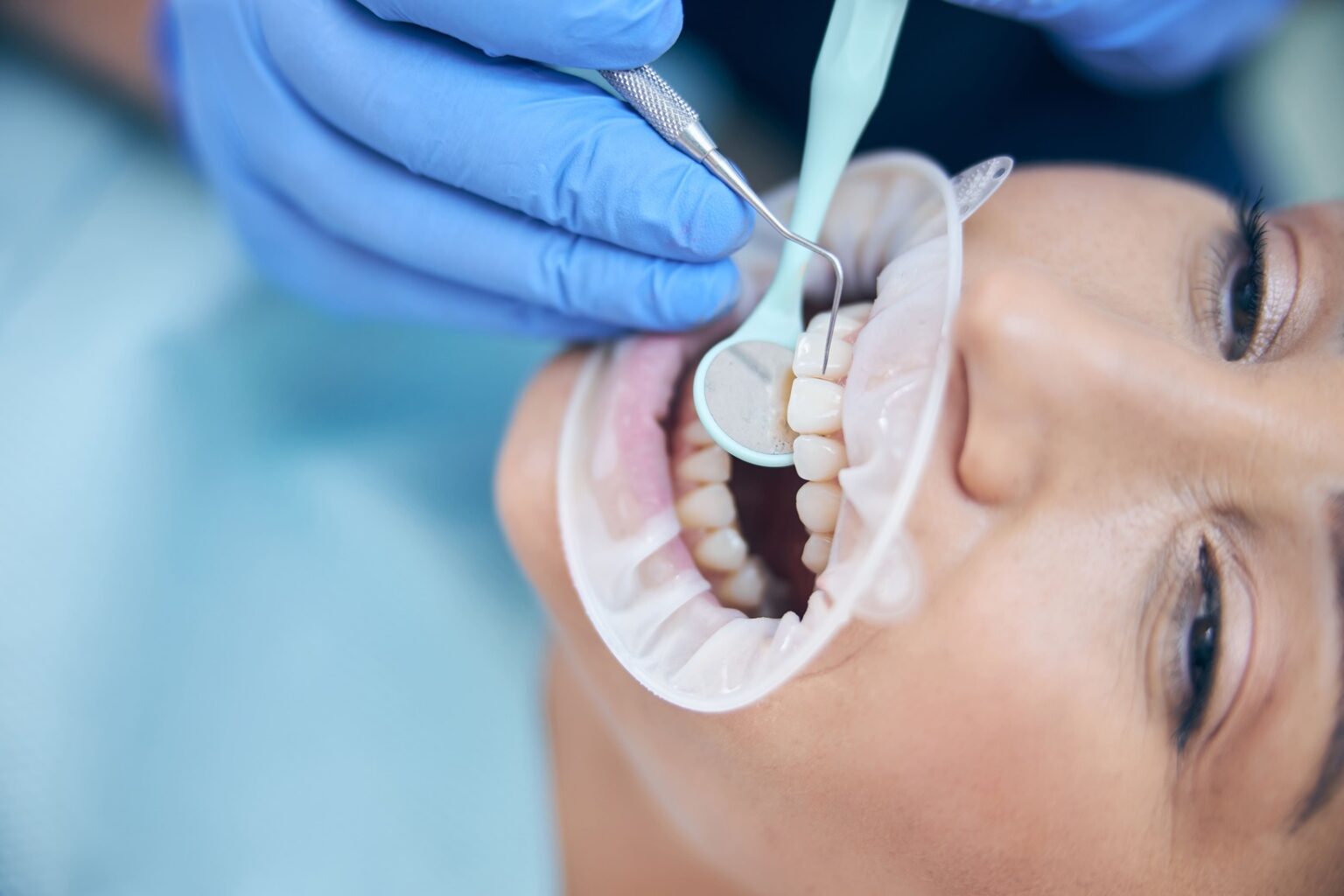Dental Filling at Solutions HSR Layout