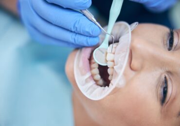 Dental Filling at Solutions HSR Layout