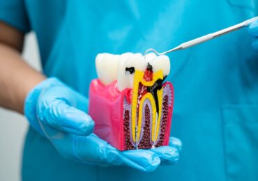 Root canal treatment at Dental Solutions dental clinic in HSR Layout