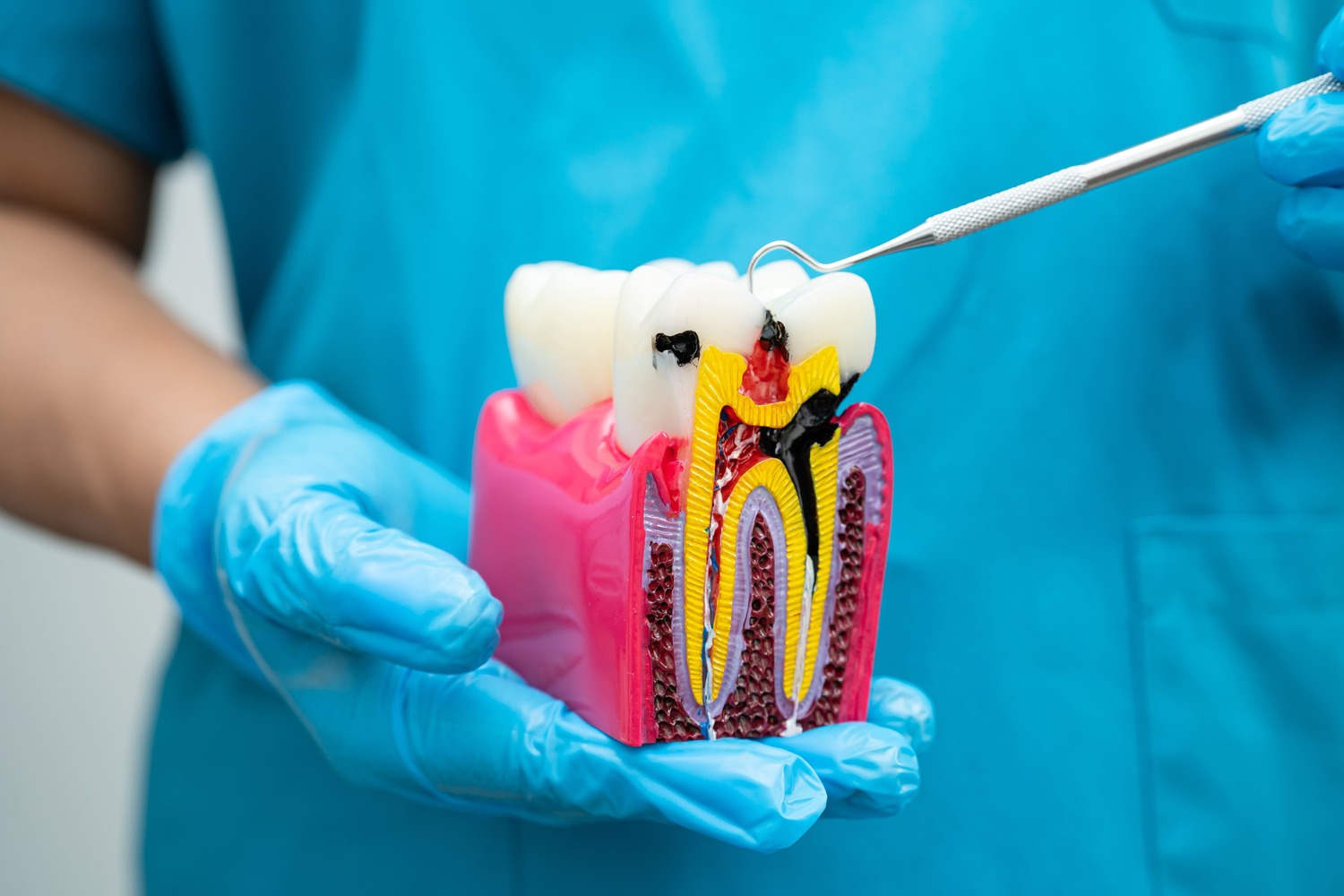 Root canal treatment at Dental Solutions dental clinic in HSR Layout