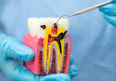 Root Canal Treatment in HSR Layout