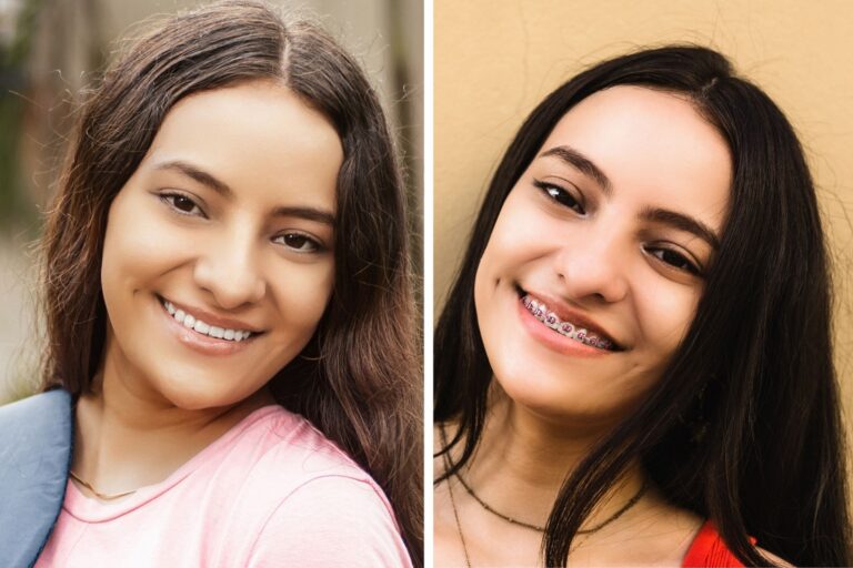 before-and-after-comparison-of dental braces