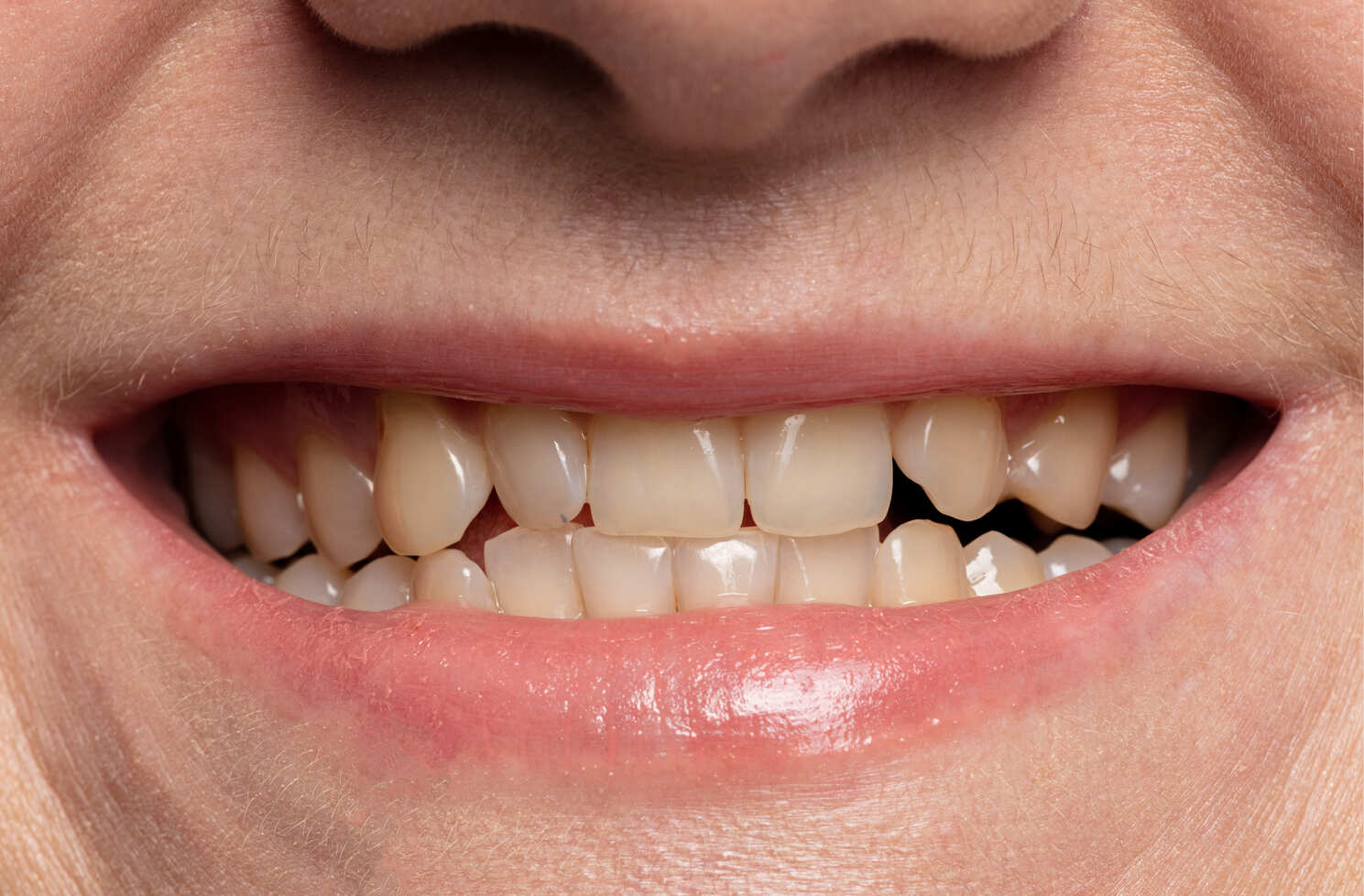 teeth-whitening-before-and-after-close-up at Dental Solutions HSR Layout