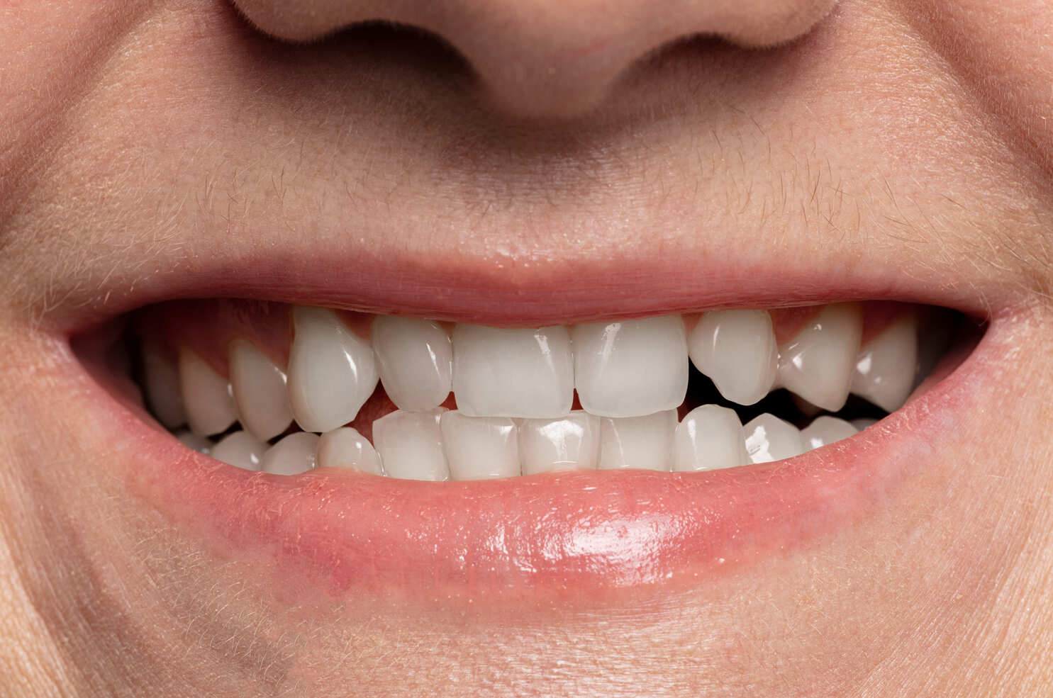 teeth-whitening-before-and-after-close-up at Dental Solutions HSR Layout